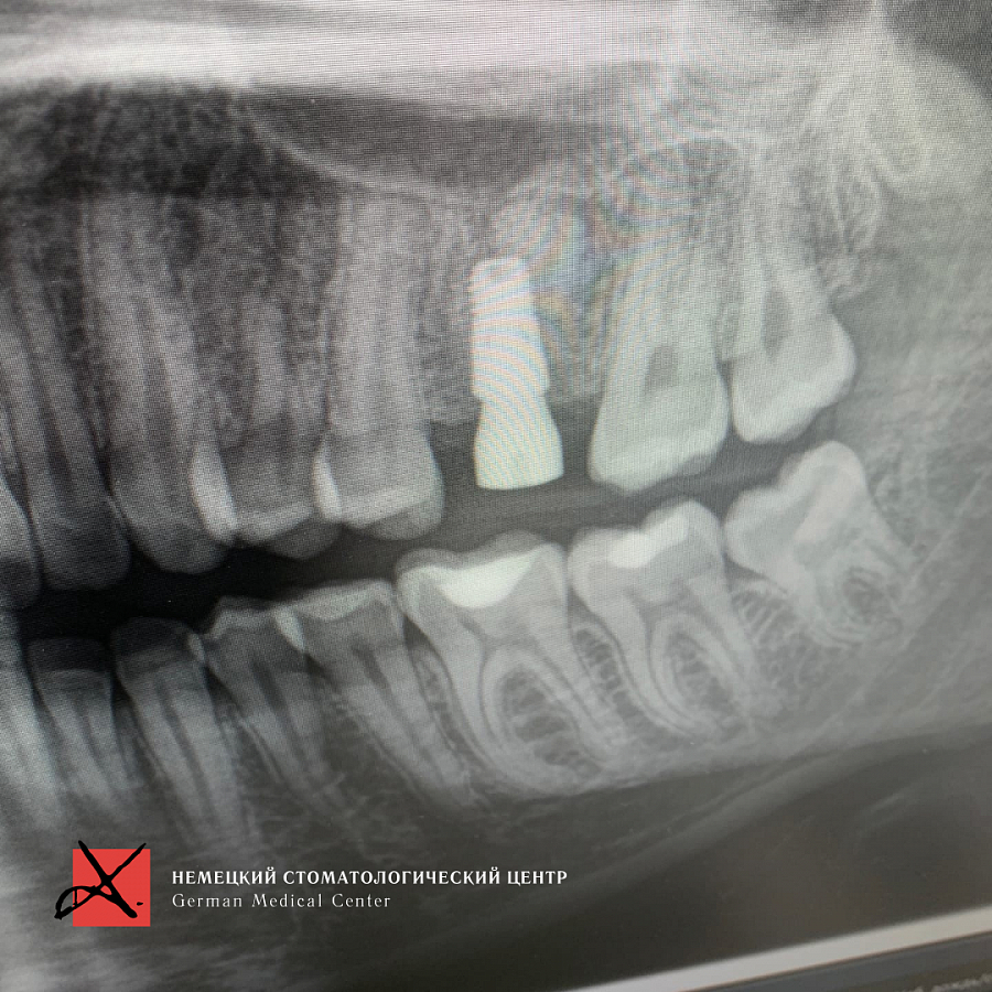 Фото работы Костная пластика с последующей имплантацией 2