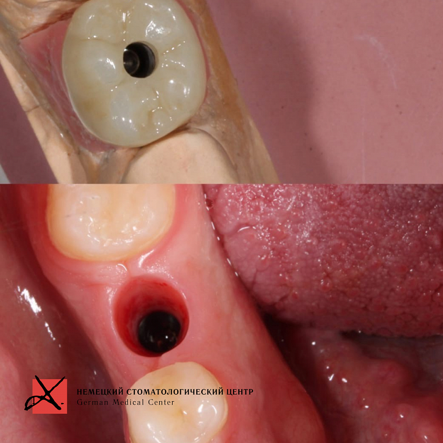 Фото работы Удаление зуба и одновременная имплантация 3