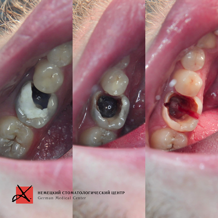 Фото работы Удаление зуба и одновременная имплантация 2