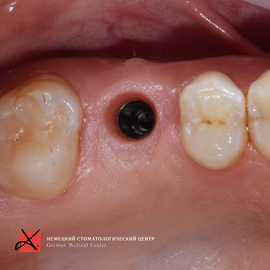 Фото работы Костная пластика с последующей имплантацией 6