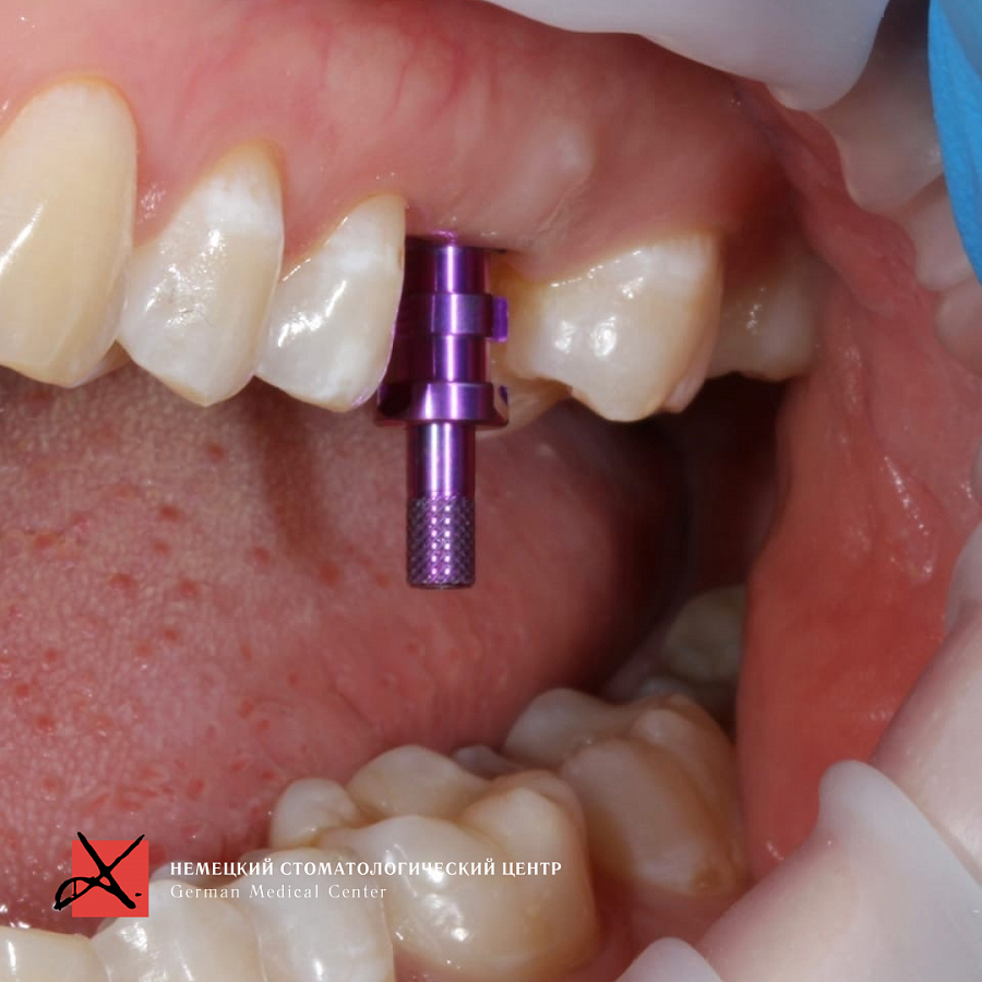 Фото работы Костная пластика с последующей имплантацией 7