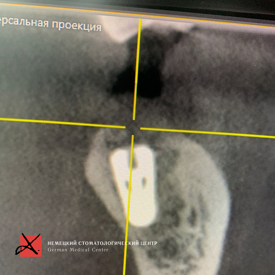 Фото работы Удаление зуба и кюретаж 2