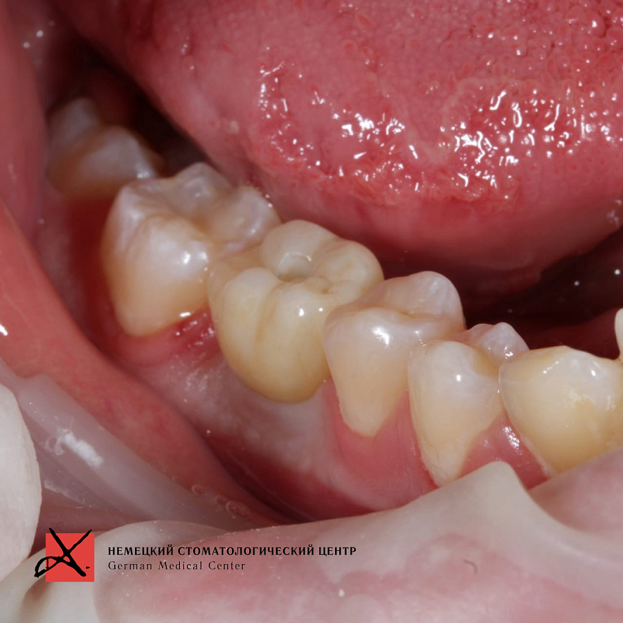 Фото работы Удаление зуба и одновременная имплантация 1