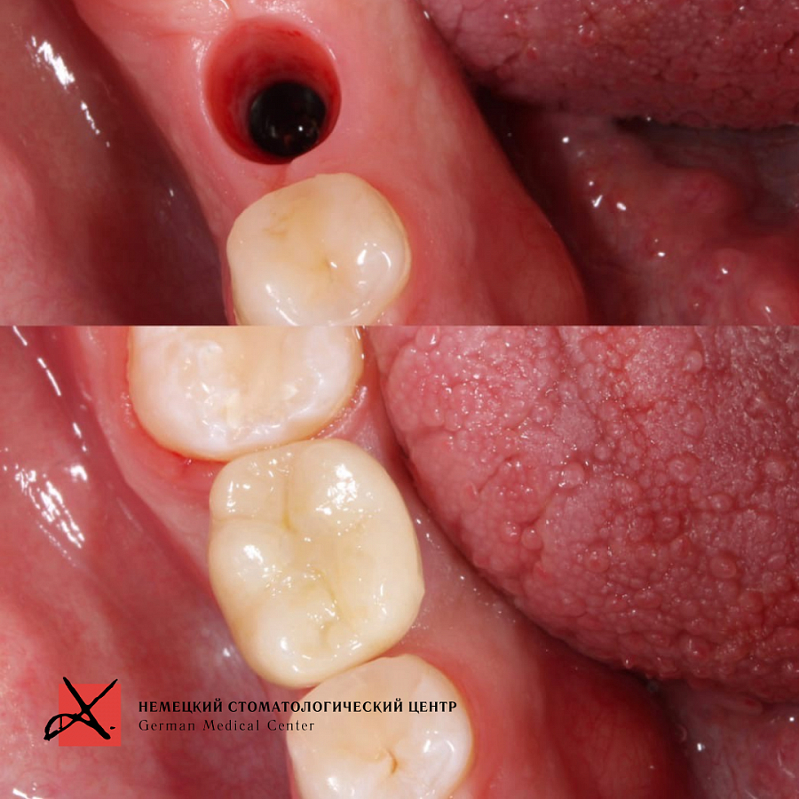 Фото работы Удаление зуба и одновременная имплантация 5